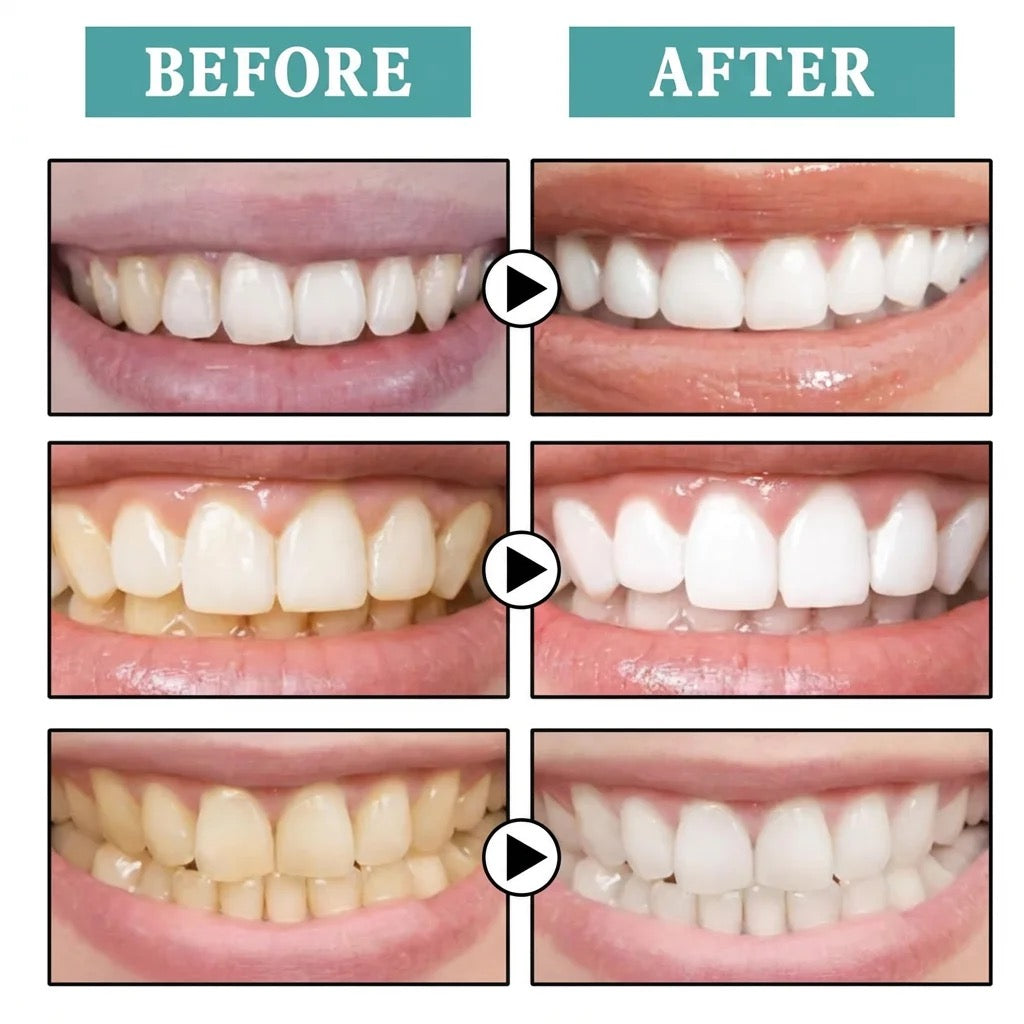 LumiSmile Teeth Whitening Pen