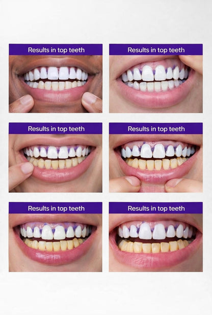 LumiSmile Whitening Strips