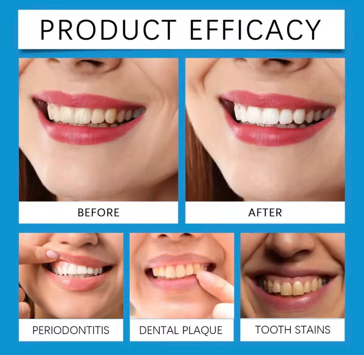 LumiSmile LED Teeth Whitening Kit